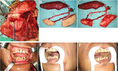 Reconstruction of Complex Lateral Skull Base Defects After Oral Cancer Resection With Individualized Anterolateral Thigh Flap